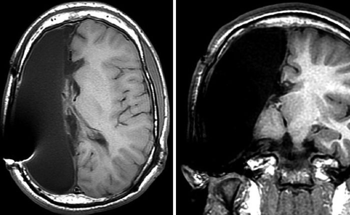 Phải cắt bỏ một nửa bộ não từ khi còn bé, những đứa trẻ này vẫn lớn lên, đi học, đi làm và thành đạt