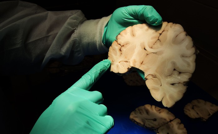 Căn bệnh bí ẩn chỉ được chẩn đoán sau khi bệnh nhân đã chết, bởi bác sĩ cần cắt não của họ