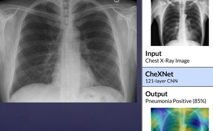 Vingroup phát triển phần mềm chẩn đoán bệnh qua ảnh X quang
