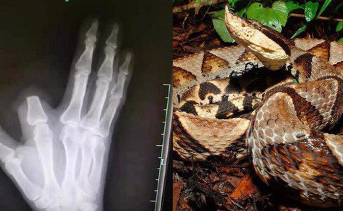 Bị rắn cắn, bác nông dân nhanh nhảu chặt phăng ngón tay nhưng đến bệnh viện thì bác sĩ bảo không cần