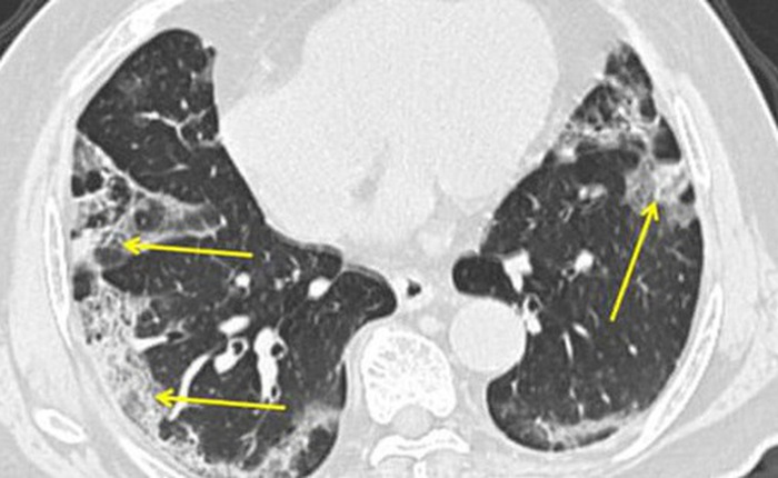 Không giống viêm phổi thông thường: Điều gì xảy ra với phổi của bệnh nhân nhiễm COVID-19?